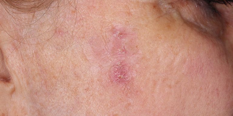 Actinic Keratosis | Skin Cancer And Reconstructive Surgery Center