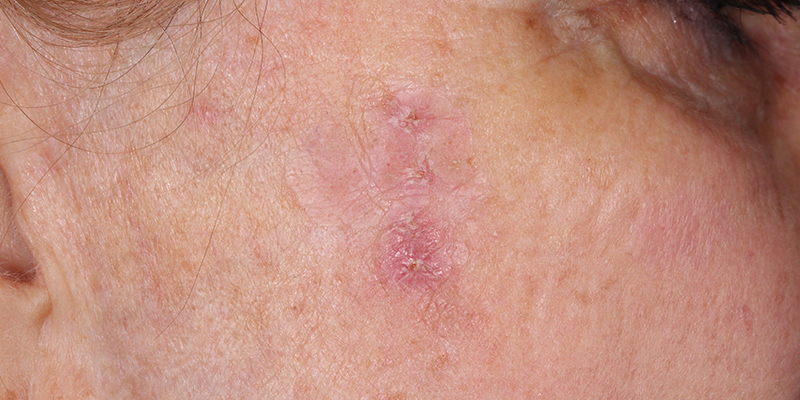Treatments for Actinic Keratosis