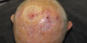 Atypical-Fibroxanthoma-of-the-Skin- AFX-Skin-Cancer-and-Reconstructive-Surgery-Center-Orange-County3