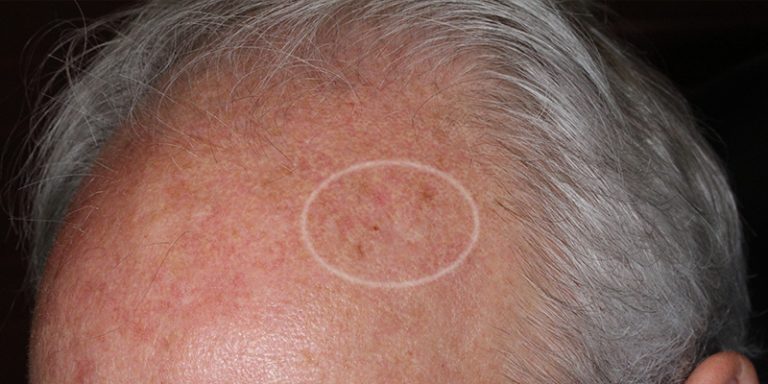 Atypical-Melanocytic-Lesion-Skin-Cancer-and-Reconstructive-Surgery