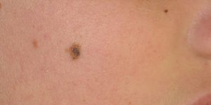 Atypical-Melanocytic-Nevus-Cheek-Skin-Cancer-and-Reconstructive-Surgery-Center-Orange-County
