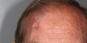 Basal-Cell-Carcinoma-Cheek-Skin-Cancer-and-Reconstructive-Surgery-Center-Orange-County2