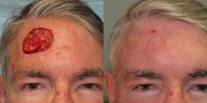 Forehead-Recontruction-After-Skin-Cancer-Excision-Skin-Cancer-And-Reconstructive-Surgery-Center-Newport-Beach-Orange-County2