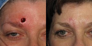 Forehead-Recontruction-After-Skin-Cancer-Excision-Skin-Cancer-And-Reconstructive-Surgery-Center-Newport-Beach-Orange-County3