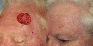 Forehead-Recontruction-After-Skin-Cancer-Excision-Skin-Cancer-And-Reconstructive-Surgery-Center-Newport-Beach-Orange-County4