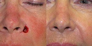 Island-Flap-2-Before-After-Skin-Cancer-And-Reconstructive-Surgery-Center-Newport-Beach-Orange-County