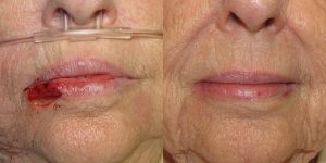 Lip-Reconstruction-After-Skin-Cancer-Excision-Skin-Cancer-And-Reconstructive-Surgery-Center-Newport-Beach-Orange-County