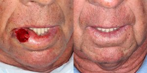 Lip-Reconstruction-After-Skin-Cancer-Excision-Skin-Cancer-And-Reconstructive-Surgery-Center-Newport-Beach-Orange-County2