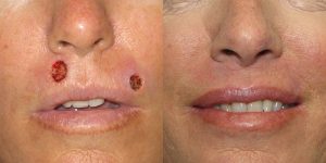 Lip-Reconstruction-After-Skin-Cancer-Excision-Skin-Cancer-And-Reconstructive-Surgery-Center-Newport-Beach-Orange-County3