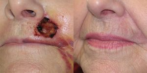 Lip-Reconstruction-After-Skin-Cancer-Excision-Skin-Cancer-And-Reconstructive-Surgery-Center-Newport-Beach-Orange-County4