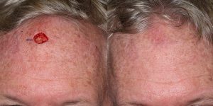 Local-Flap-Before-After-Skin-Cancer-And-Reconstructive-Surgery-Center-Newport-Beach-Orange-County
