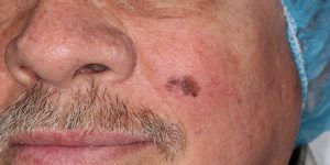 Melanoma-Cheek-Skin-Cancer-and-Reconstructive-Surgery-Center-Orange-County