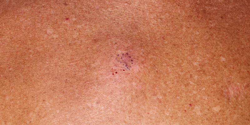 Melanoma In Situ - Treatment