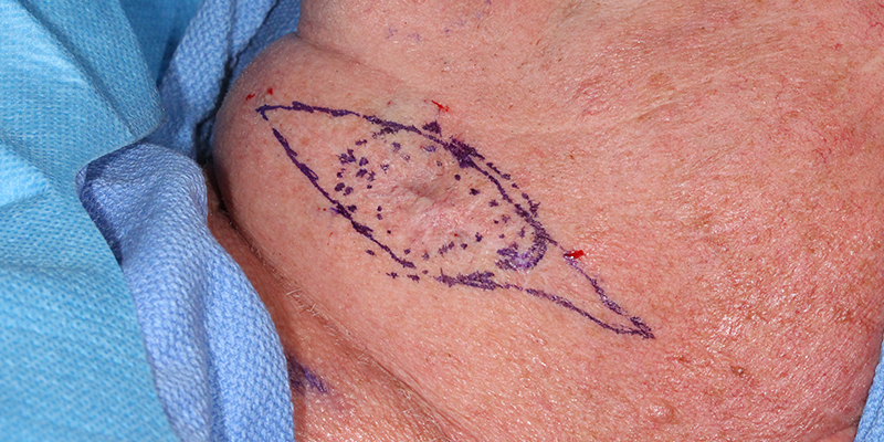 infiltrative basal cell carcinoma