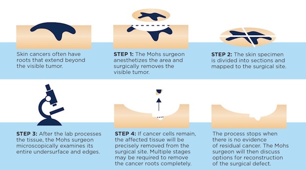 Mohs Micrographic Surgery