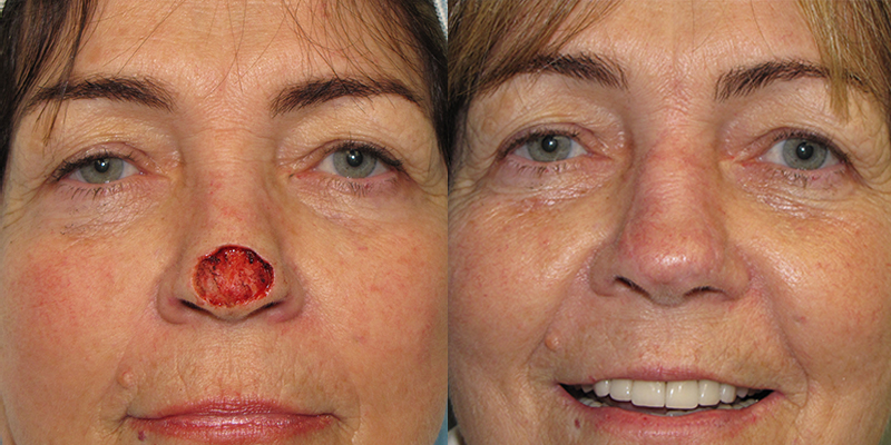 Nose Reconstruction After Skin Cancer Excision Skin Cancer And
