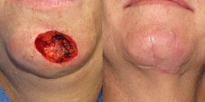 Reconstructive-Surgery-Skin-Cancer-SCC-Chin-Orange-County-Skin-Cancer-Reconstructive-Surgery-Center2