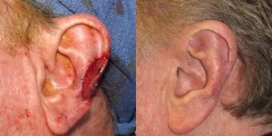 Reconstructive-Surgery-Skin-Cancer-Skin-Cancer-Ear-Orange-County-Skin-Cancer-Reconstructive-Surgery-Center1