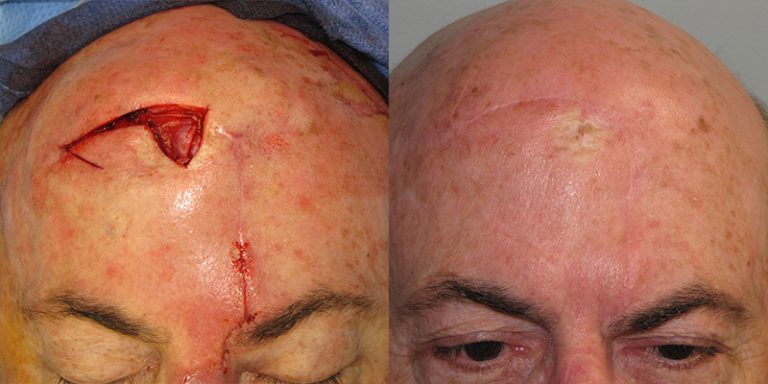 Scalp-Reconstruction-After-Skin-Cancer-Excision-Skin-Cancer-And