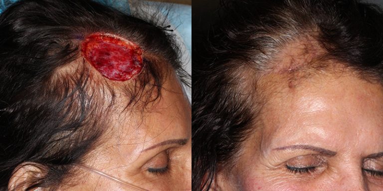 Scalp Reconstruction After Skin Cancer Excision Skin Cancer And Reconstructive Surgery Center