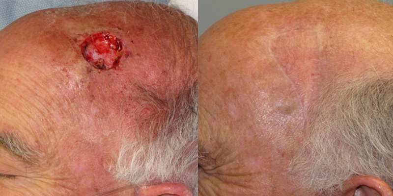 Scalp Reconstruction Gallery Skin Cancer And Reconstructive Surgery