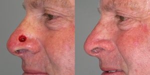 Secondary-Intention-Healing-Before-After-Skin-Cancer-And-Reconstructive-Surgery-Center-Newport-Beach-Orange-County