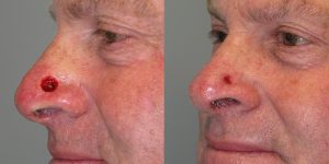 Secondary-Intention-Healing-Skin-Cancer-And-Reconstructive-Surgery-Center-Newport-Beach-Orange-County