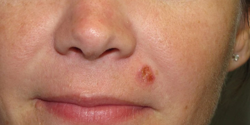 Squamous Cell Carcinoma Skin Cancer And Reconstructive Surgery Center