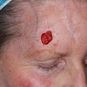 Forehead-Reconstruction-After-Skin-Cancer-Excision-Skin-Cancer-And-Reconstructive-Surgery-Center-Newport-Beach-Orange-County300x300