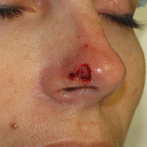 Nose-Reconstruction-After-Skin-Cancer-Excision-Skin-Cancer-And-Reconstructive-Surgery-Center-Newport-Beach-Orange-County300x300