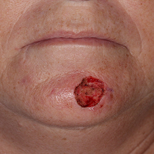 Reconstructive Surgery Skin Cancer SCC Chin