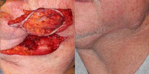 Skin-Cancer-And-Reconstructive-Surgery-Center-Skin-Cancer-Body (4)