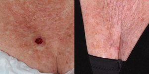 Skin-Cancer-And-Reconstructive-Surgery-Center-Skin-Cancer-Body (7)