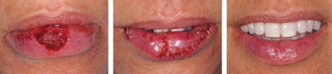 Myomucosal Lip Island Flap Before and After