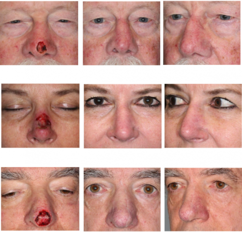 paramedian forehead flap before and after